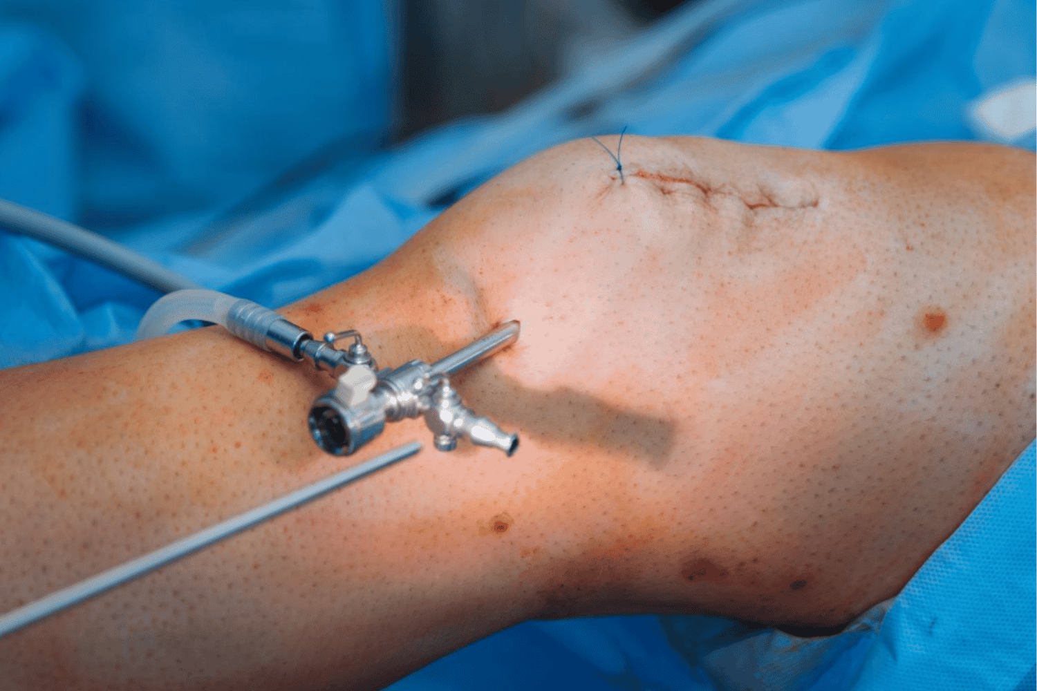 Knee Arthroscopy
